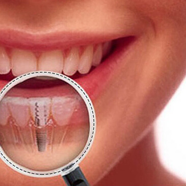 Dental Implants