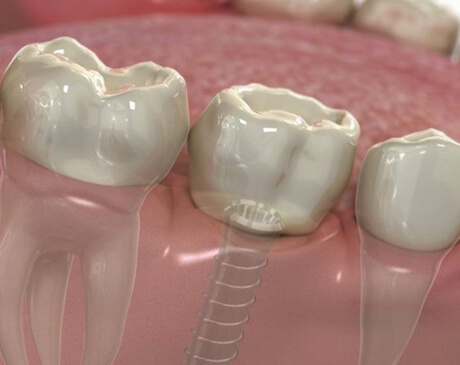 implants hove dental clinic implants close up