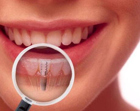 implants face smile implants face smile