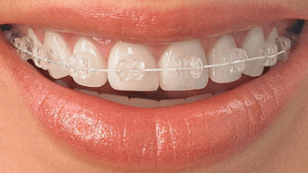 clear braces