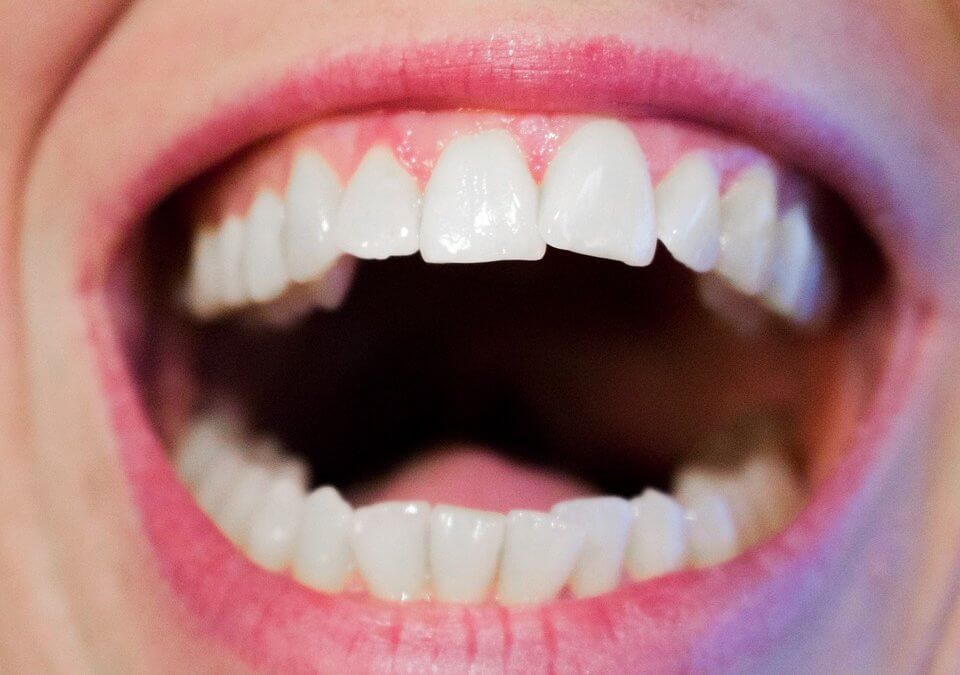 Everything You Need to Know About Crooked Teeth