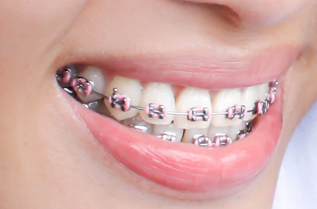 Dental Braces