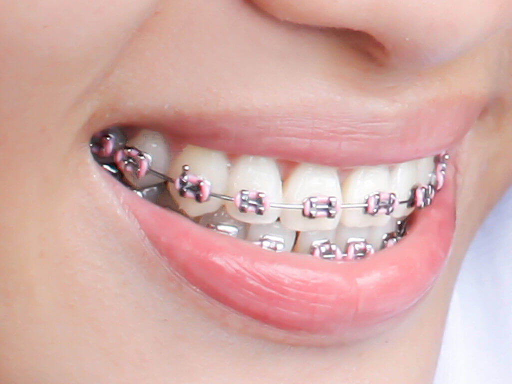 https://www.hovedentalclinic.co.uk/wp-content/uploads/2019/03/Braces-1024x768.jpg