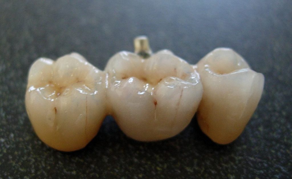 what is a dental bridge