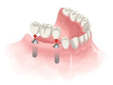 your dental bridge procedure