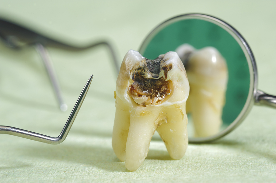 Rotten Teeth: Causes, Symptoms and Treatments