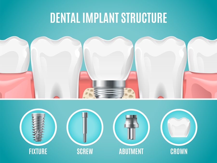 tooth implant