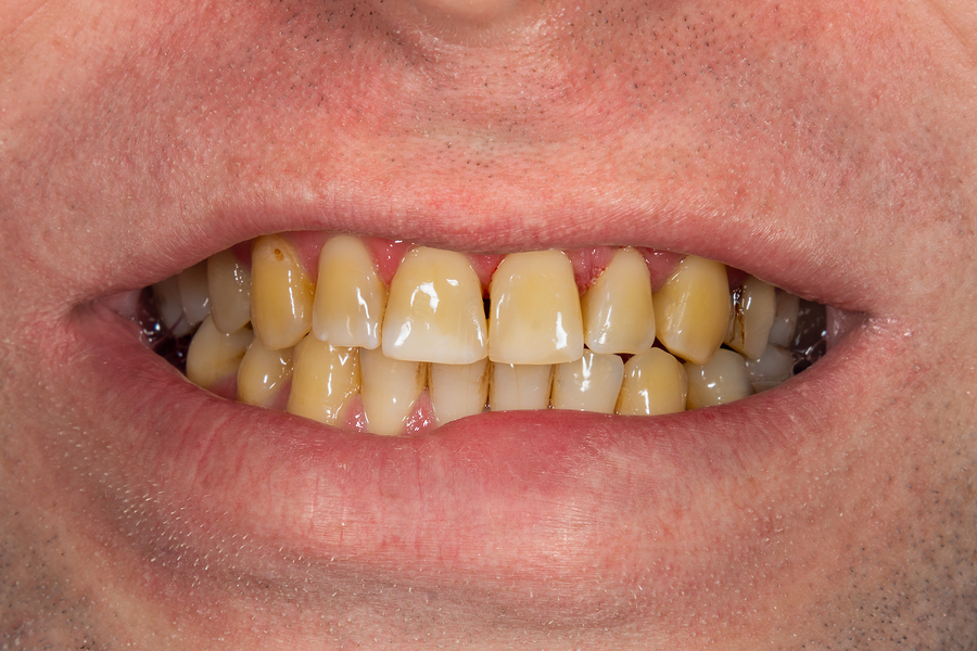 How Do Teeth Stain and How Do You Get Rid of Badly Stained Teeth?