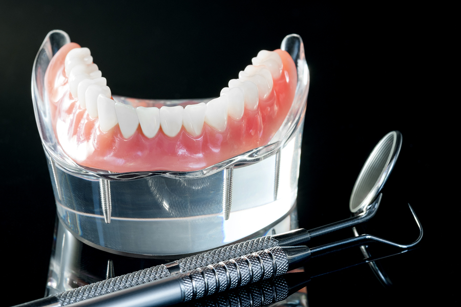 Teeth Model Showing An Implant Crown Bridge Model/ Dental Demons