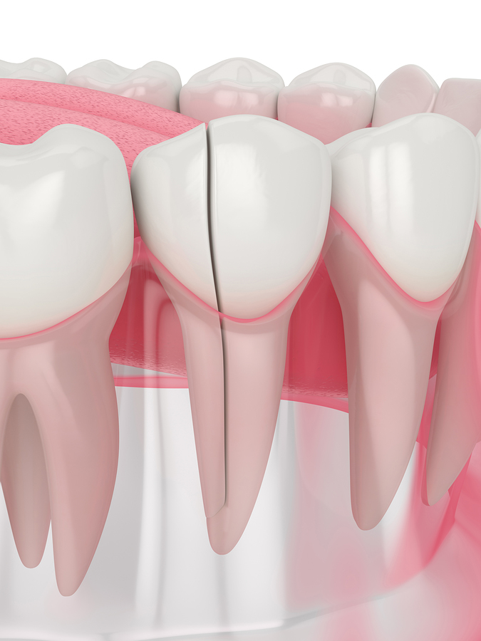 Cracked tooth 3D render, crack moving down the root.