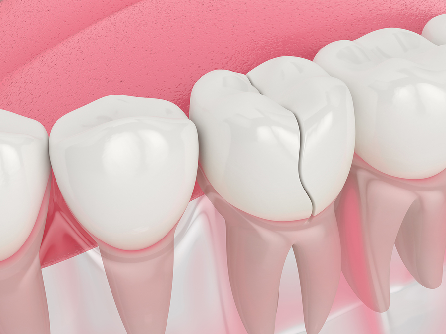 Best Temporary Filling Kits (UK): Repair a Tooth at Home