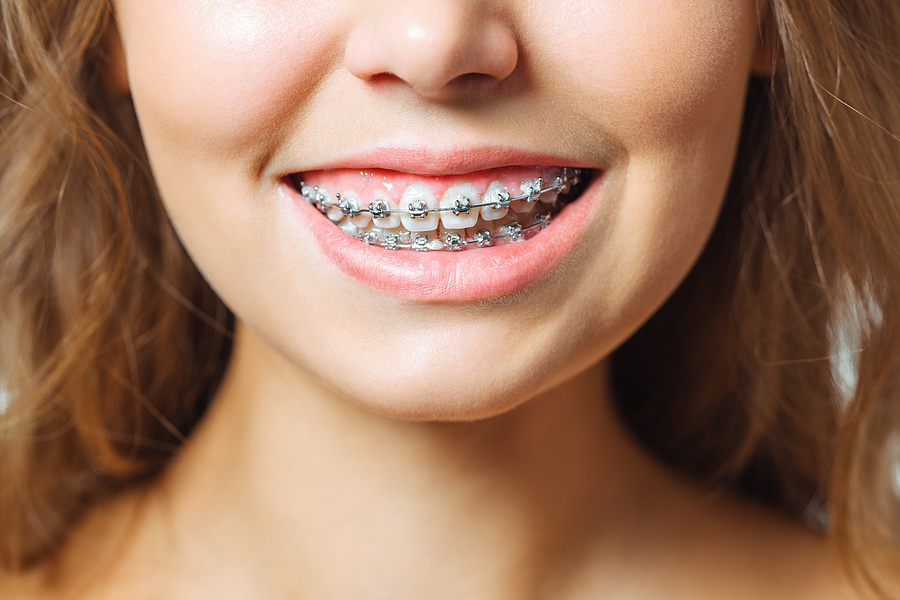 Your Guide to Getting Braces: Before, During and After Treatment