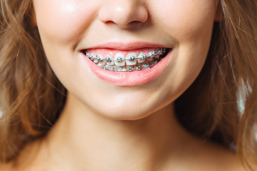 Ceramic braces: Pros and cons, cost, and results