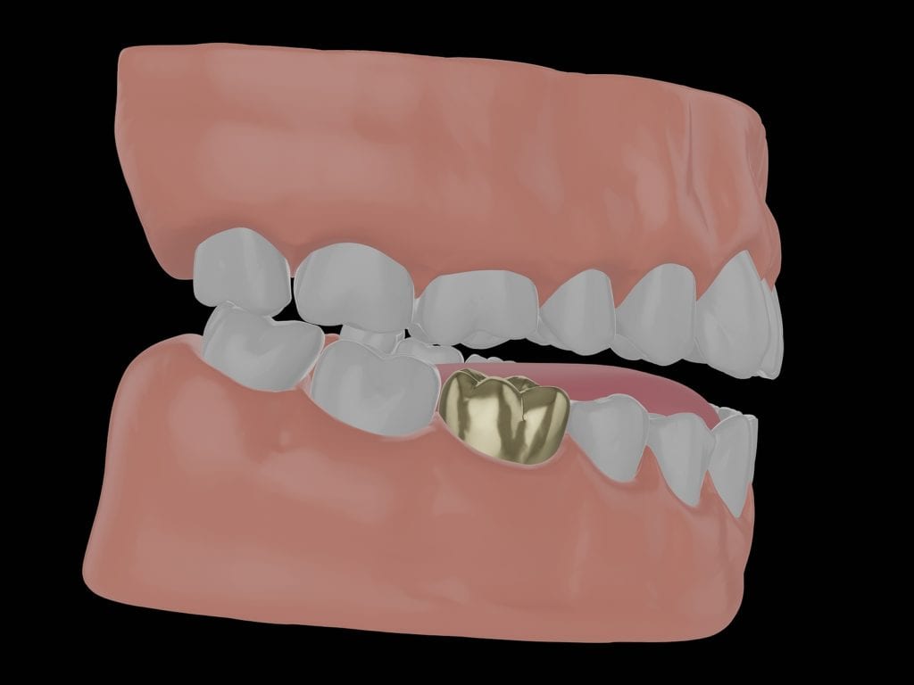 gold tooth crown