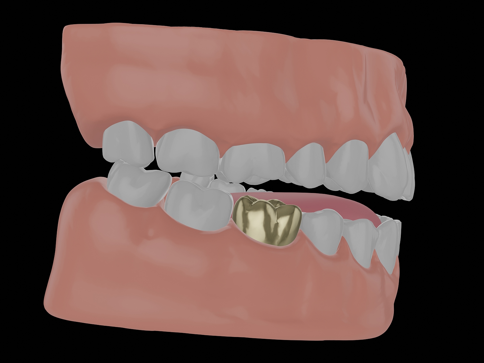 bigstock Human Jaw With Gold Tooth Gol 376594543