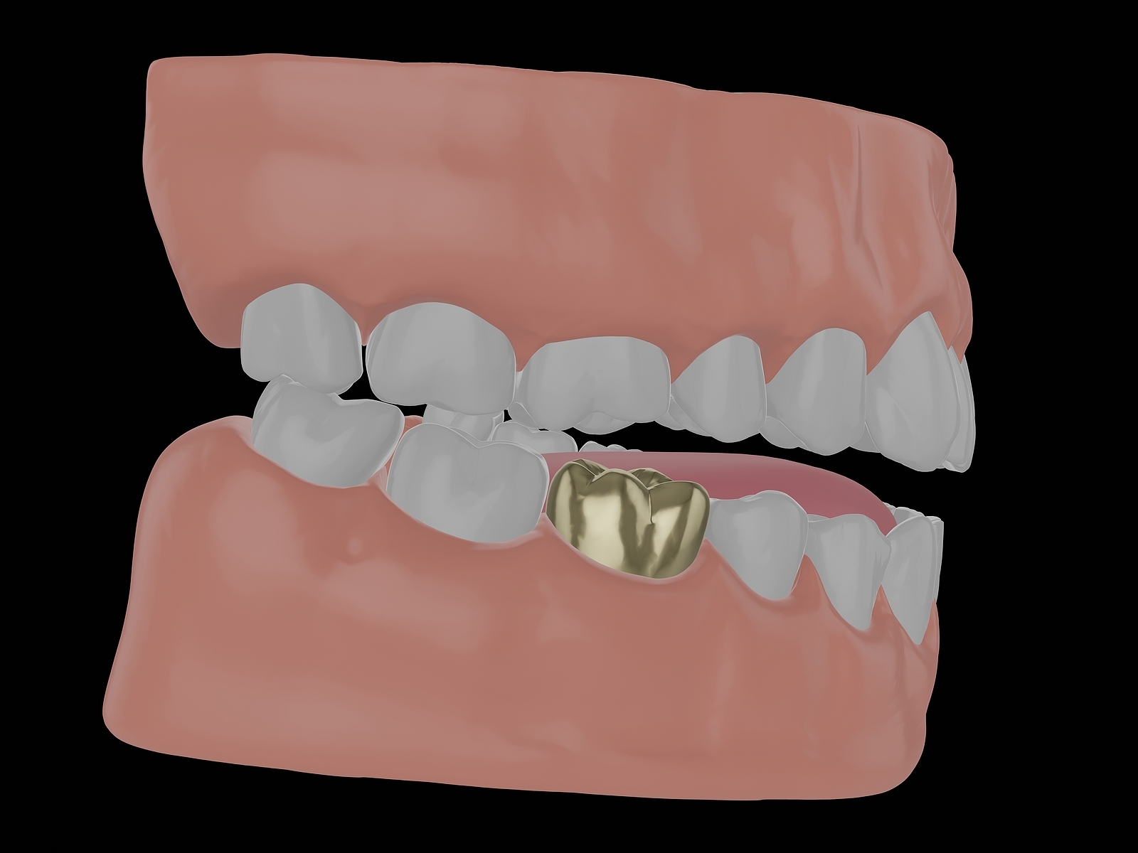 gold tooth bridge