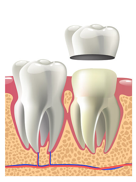 dental crown