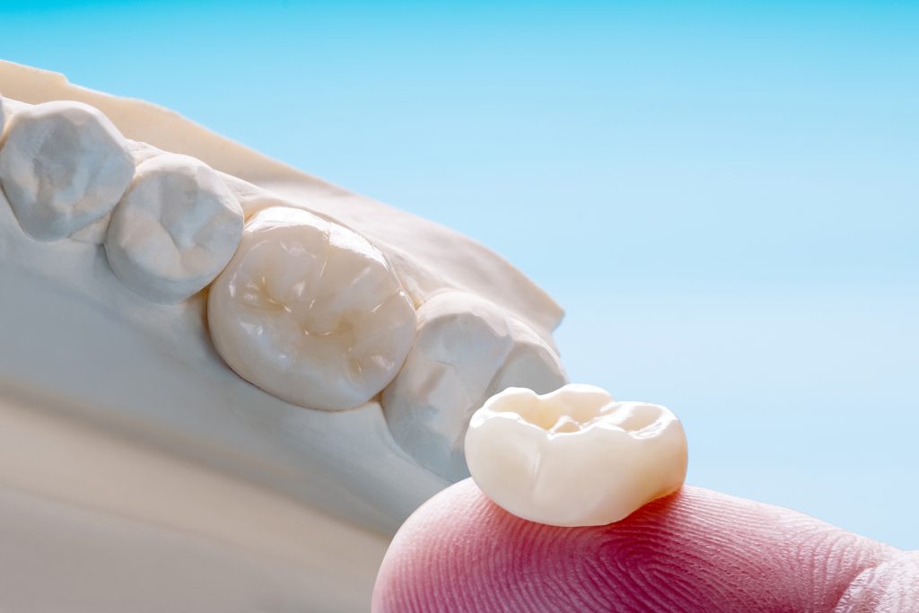 Molar tooth crown with bridge equipment