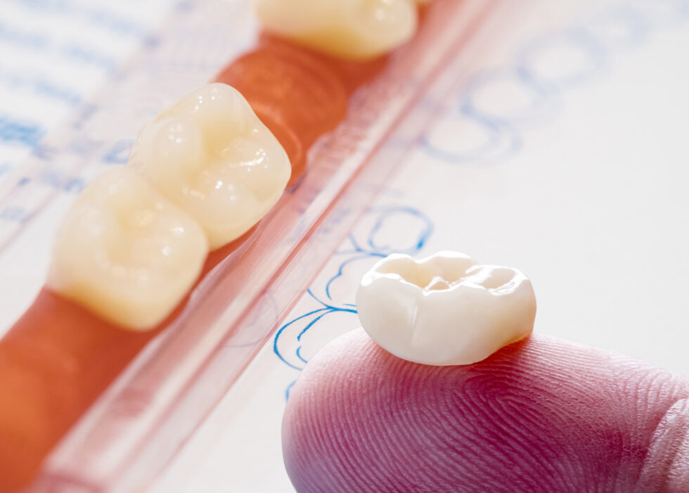 Crown Replacement Process, Costs and Insurance