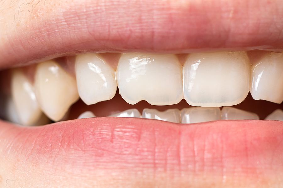 Repairing chips and cracks in teeth