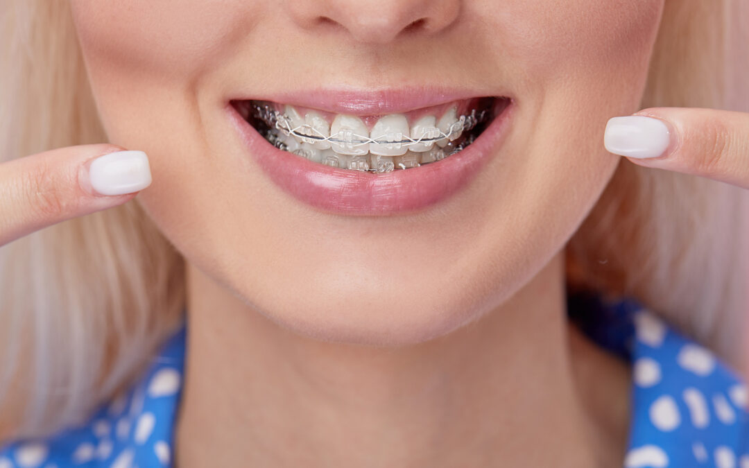 a blonde woman smiling while wearing clear bracket braces on her teeth