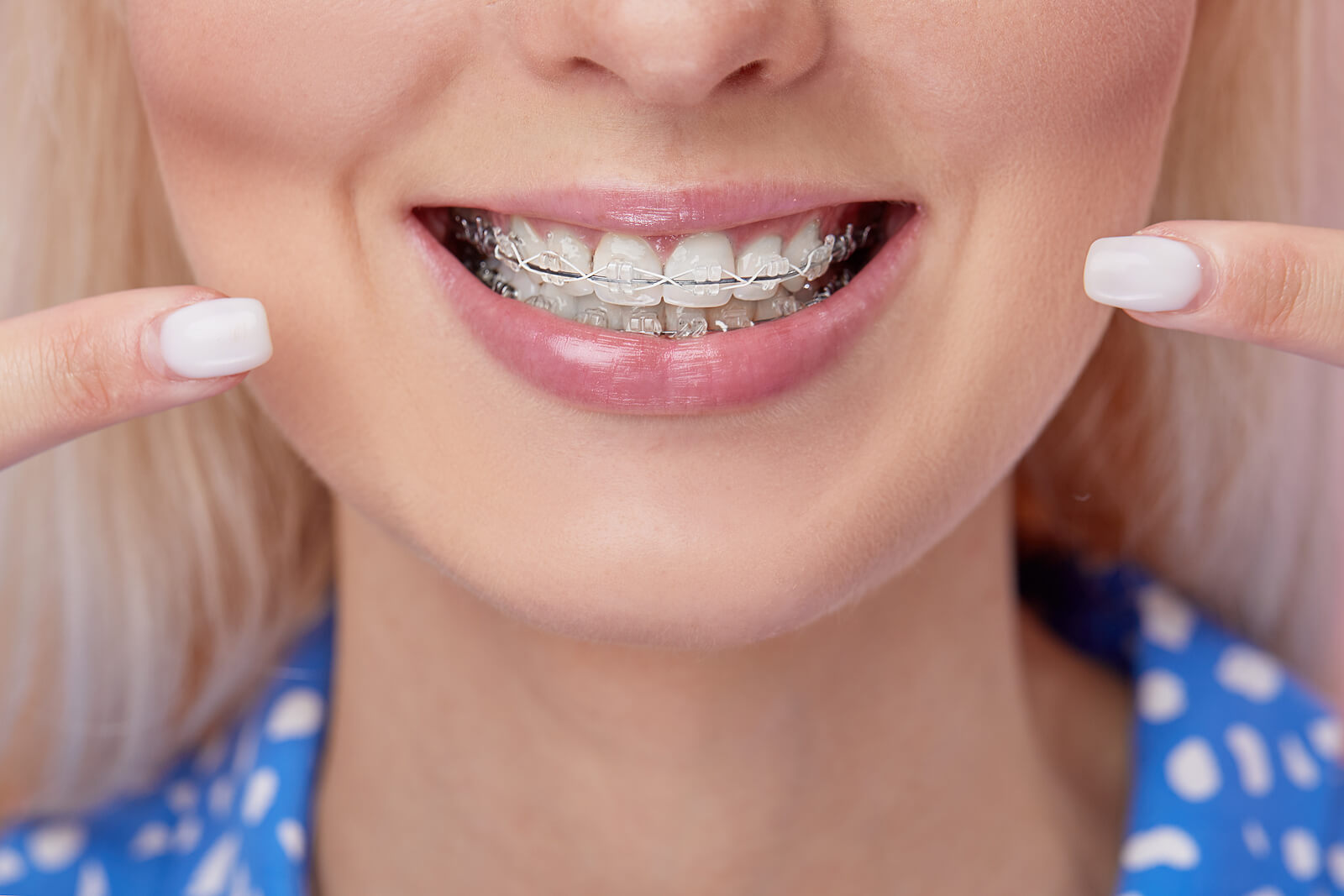 a blonde woman smiling while wearing clear bracket braces on her teeth