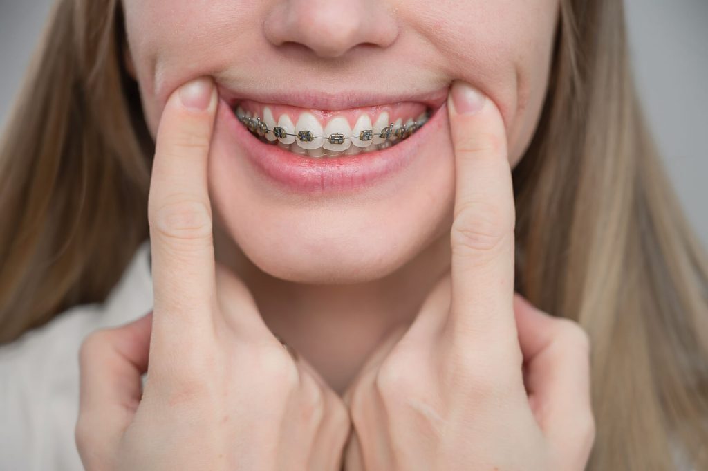 a close-up of a young woman smiling with metal braces on her teeth