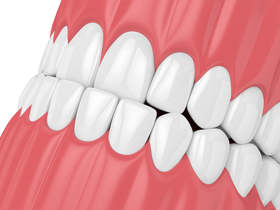 underbite