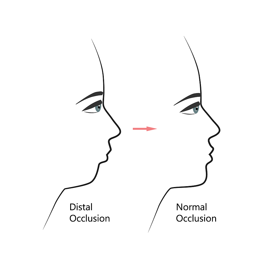 Overbite or Buck Teeth: Everything You Need to Know About its