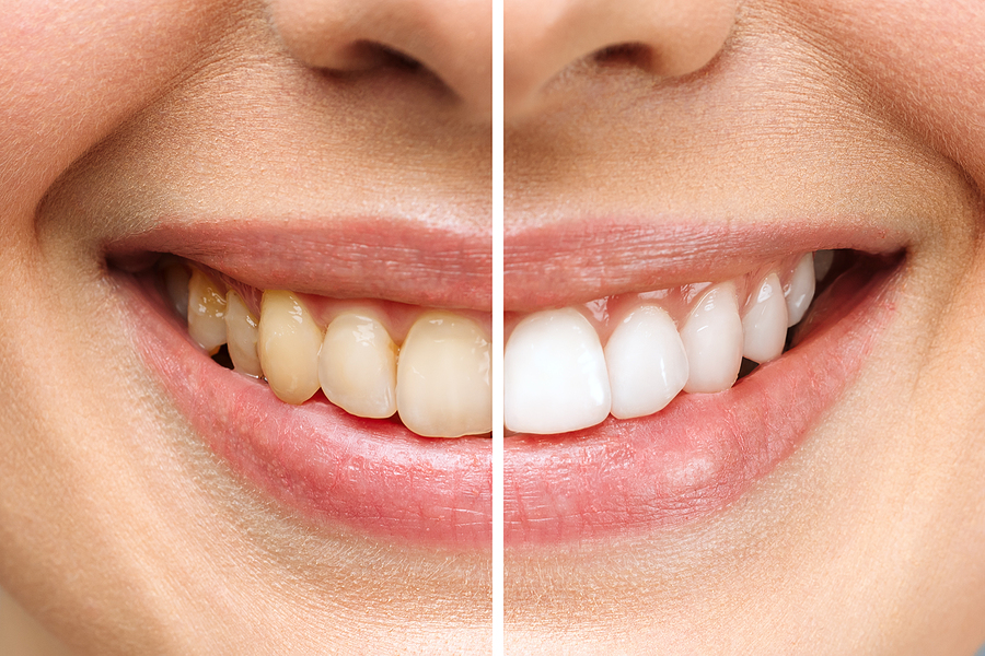 Woman Teeth Before And After Whitening. Over White Background. D - Hove  Dental Clinic