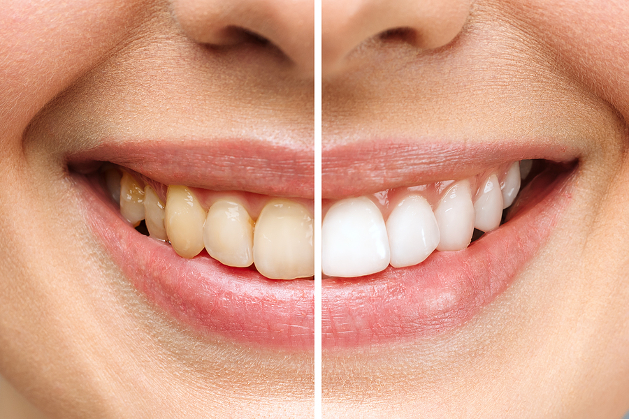 Woman Teeth Before And After Whitening. Over White Background. D teeth whitening