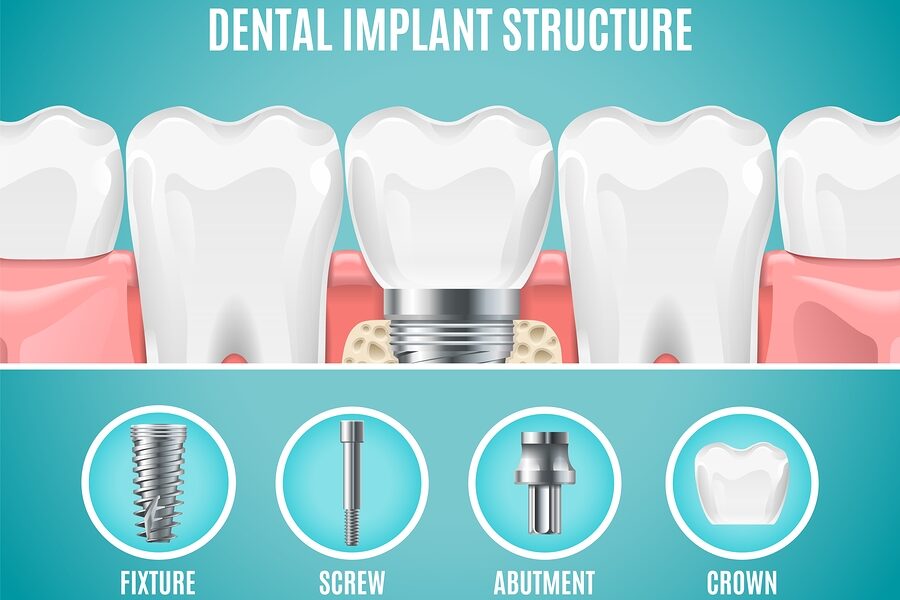 tooth implant