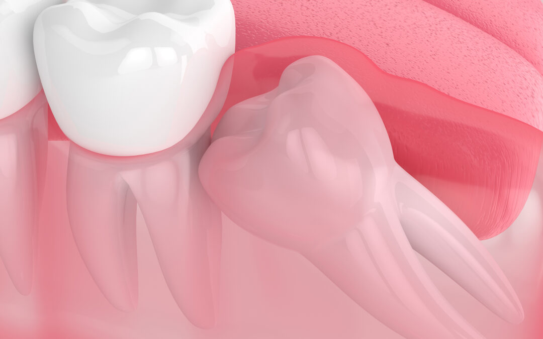 What is an Impacted Tooth?