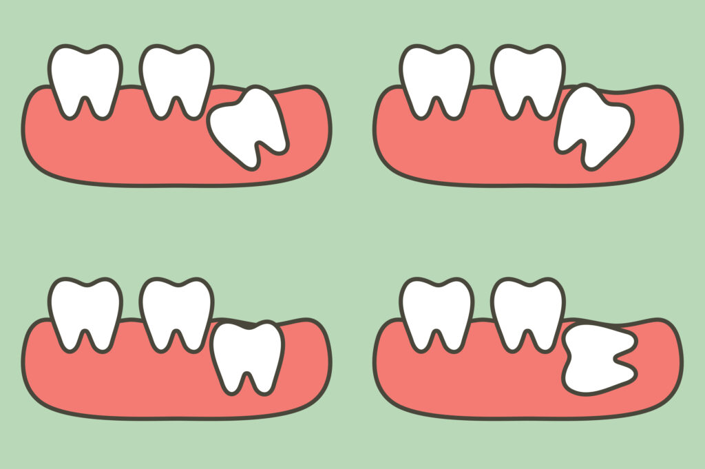 type of wisdom tooth affect to other teeth