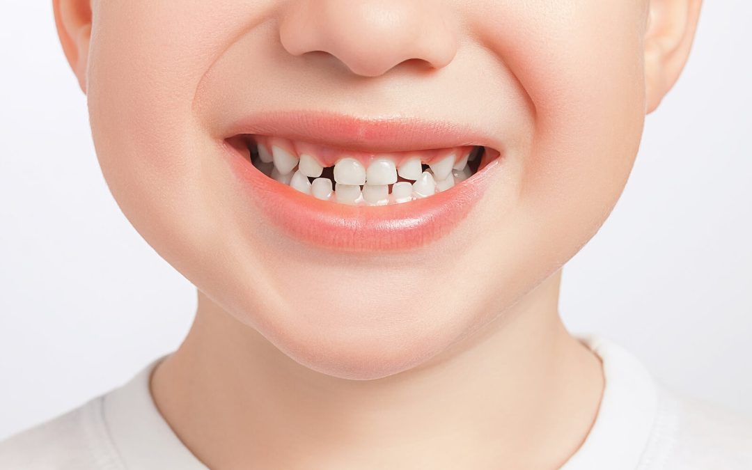 What is Diastema?