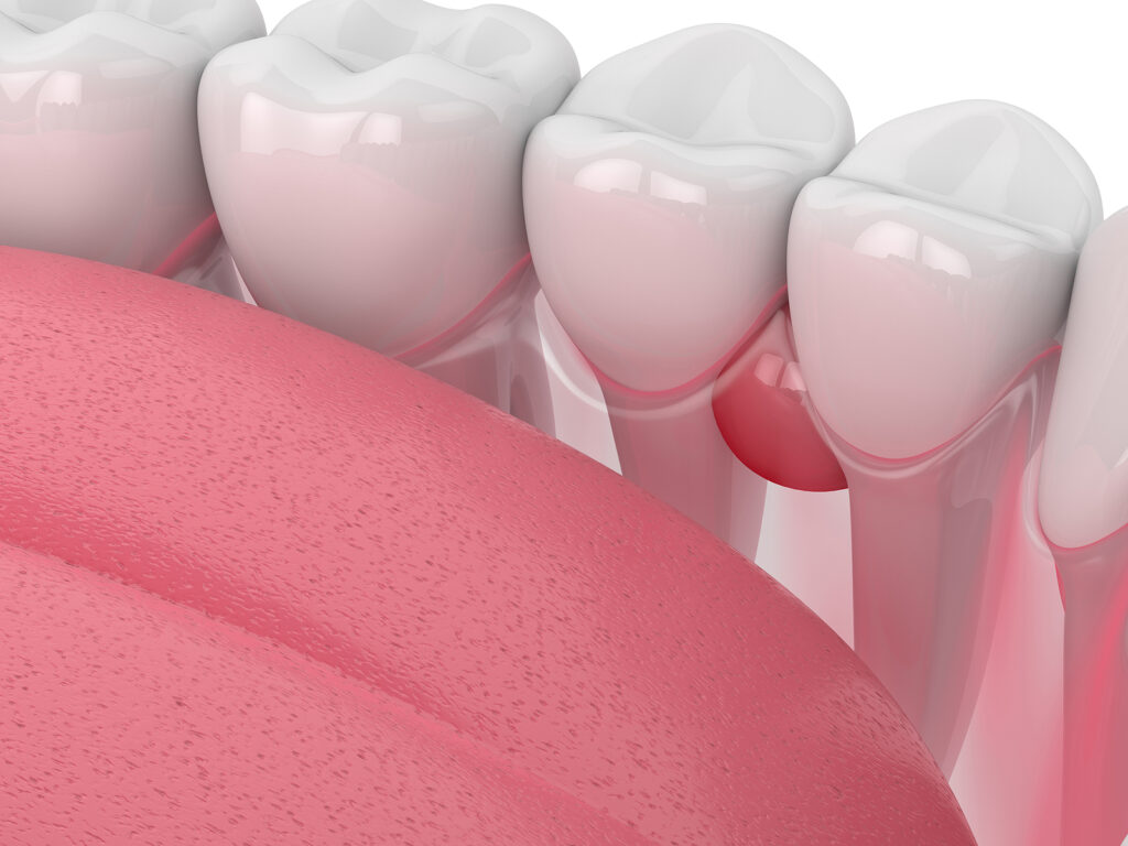 3d Render Of Teeth In Gums With Cyst Over White Background. Dent