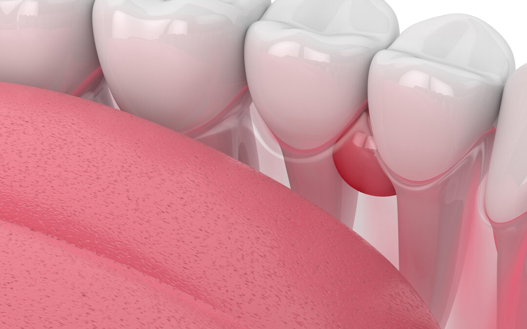 3d Render Of Teeth In Gums With Cyst Over White Background. Dent