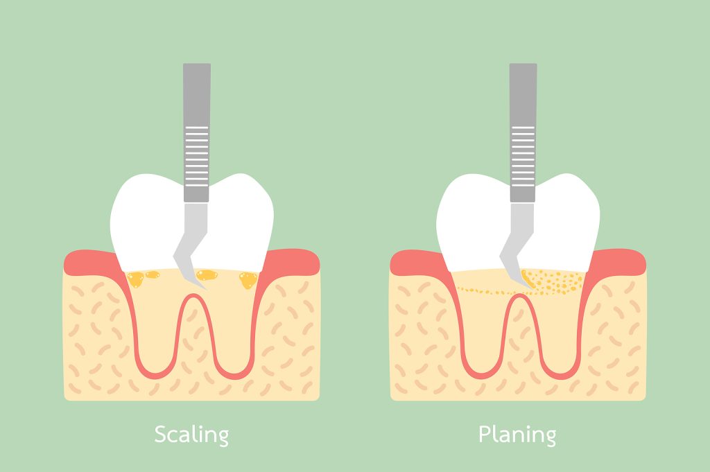 teeth scaling - dental plaque removal, anatomy structure including the bone and gum