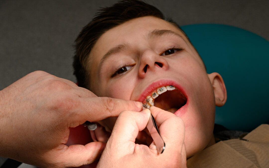 Do Braces Hurt? FAQs & How Long It Will Take to Wear Braces Comfortably