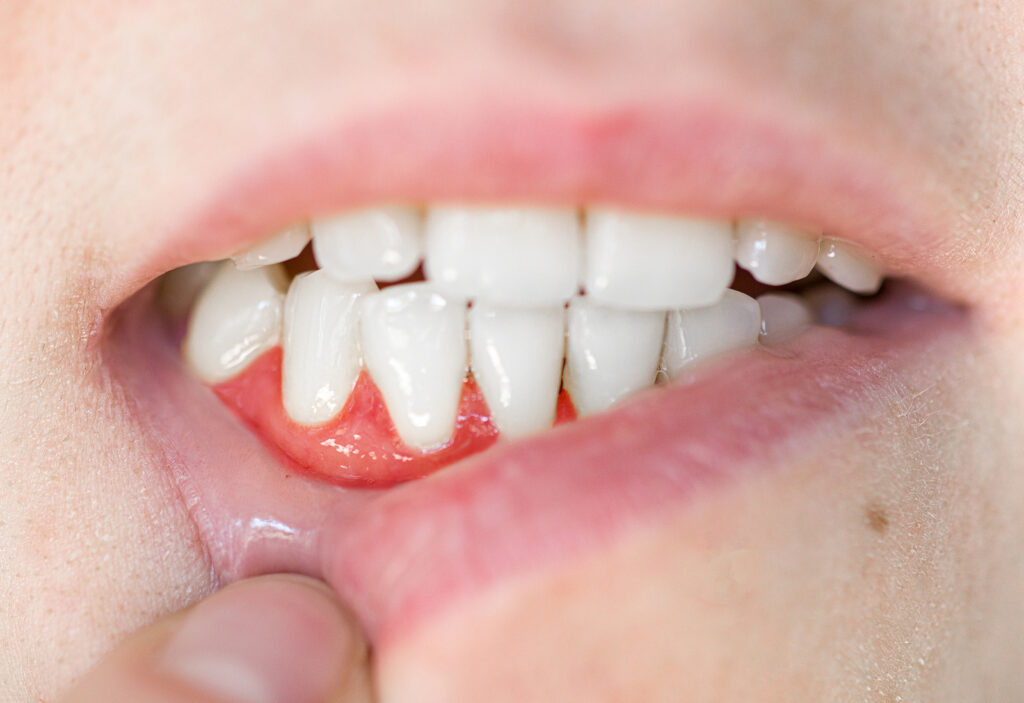 close-up of teeth. gum disease in a woman, periodontal disease. tartar removal, dental treatment