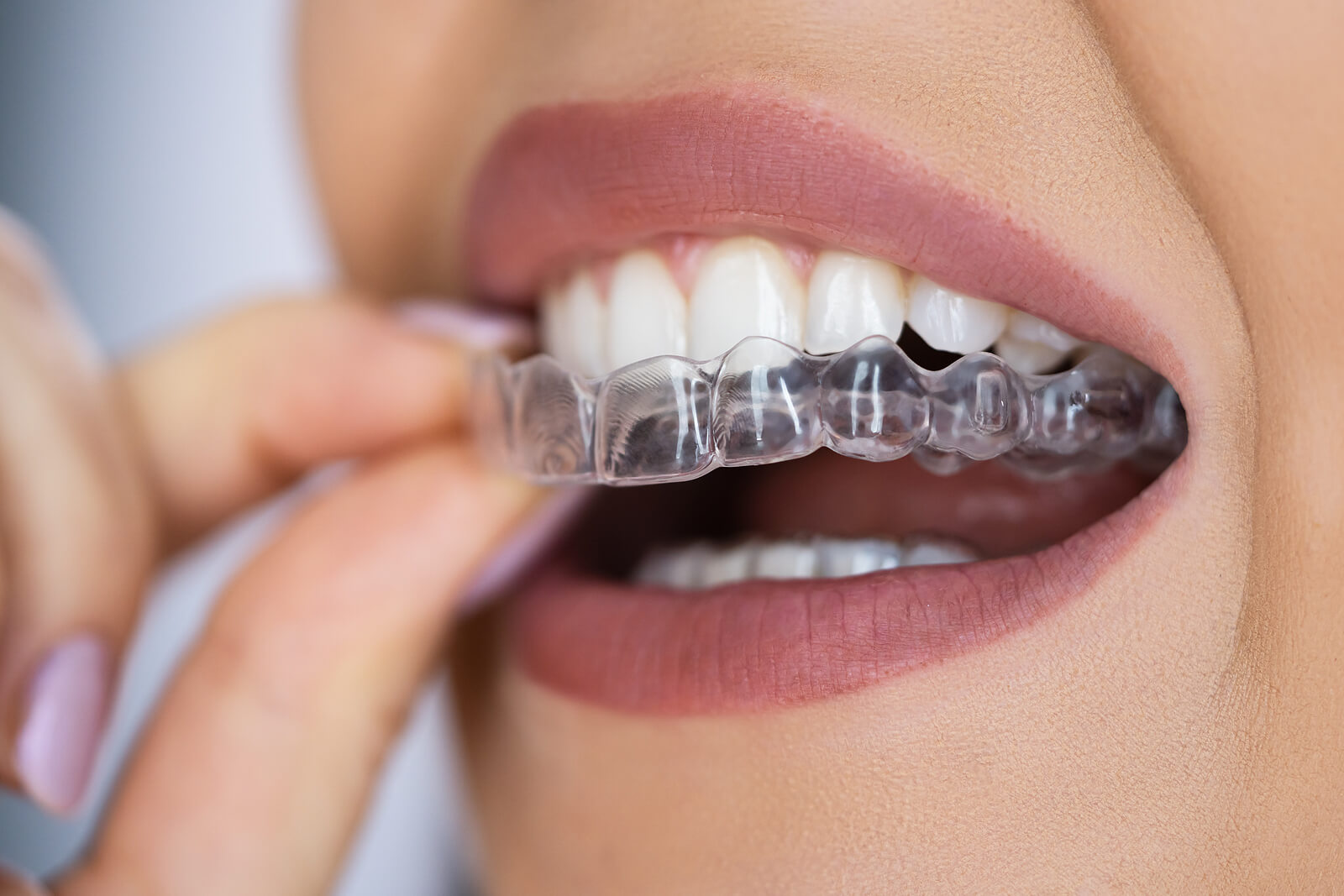 What Do Invisalign Braces Cost? Are They Worth It?